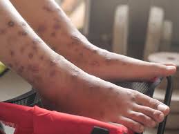 CDC Warns of Dangerous Fungal Infection Spreading Through US at ‘Alarming Rate’