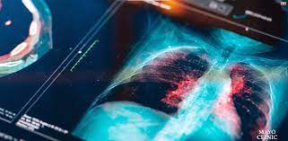 Daily Pill May Cut Lung Cancer Mortality in Half: Study