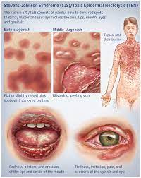Stevens-Johnson Syndrome