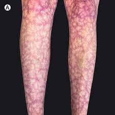 Purplish Discoloration of the Legs: An Unusual Long-COVID Symptom