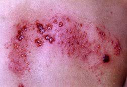 The Essential Guide to Shingles (Herpes Zoster): Symptoms, Causes, Treatments, and Natural Approaches