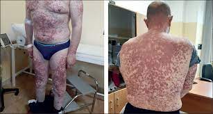 COVID Vaccines Could Trigger Vasculitis, Damaging Multiple Organs