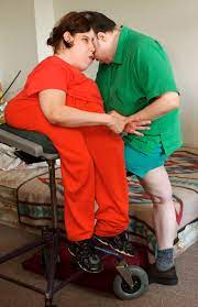 Oldest Living Conjoined Twins, Lori and George Schappell, Die at 62