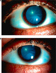 Study Finds Elevated Risk of Eye Inflammatory Disorder Following COVID-19 Vaccination