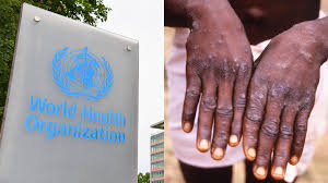 World Health Organization Declares Monkeypox Public Health Emergency