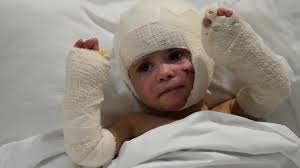 Traumatized by war, hundreds of Lebanon’s children struggle with wounds both physical and emotional